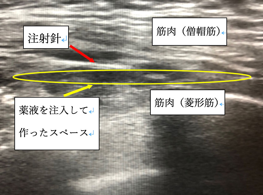 第5回 そもそも肩こりとは 横浜 みなとみらいの整形外科ならプライムコーストみなとみらいクリニック